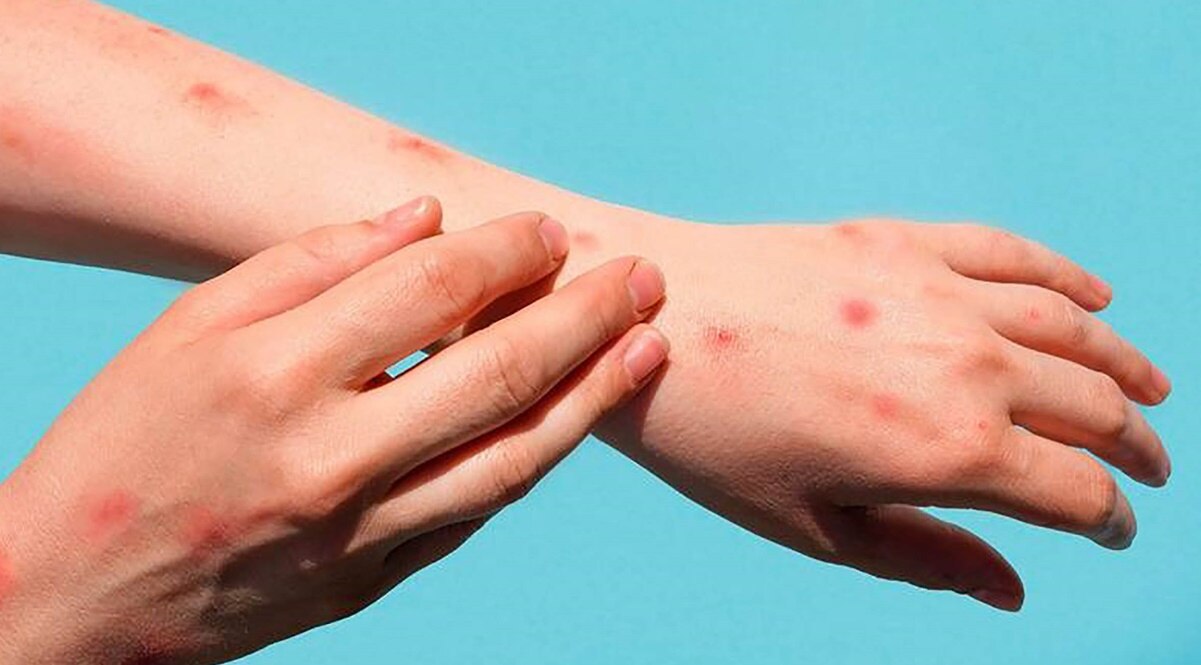 Reporta Salud de SLP tres casos sospechosos de viruela del mono en el estado. Foto: Archivo EL UNIVERSAL