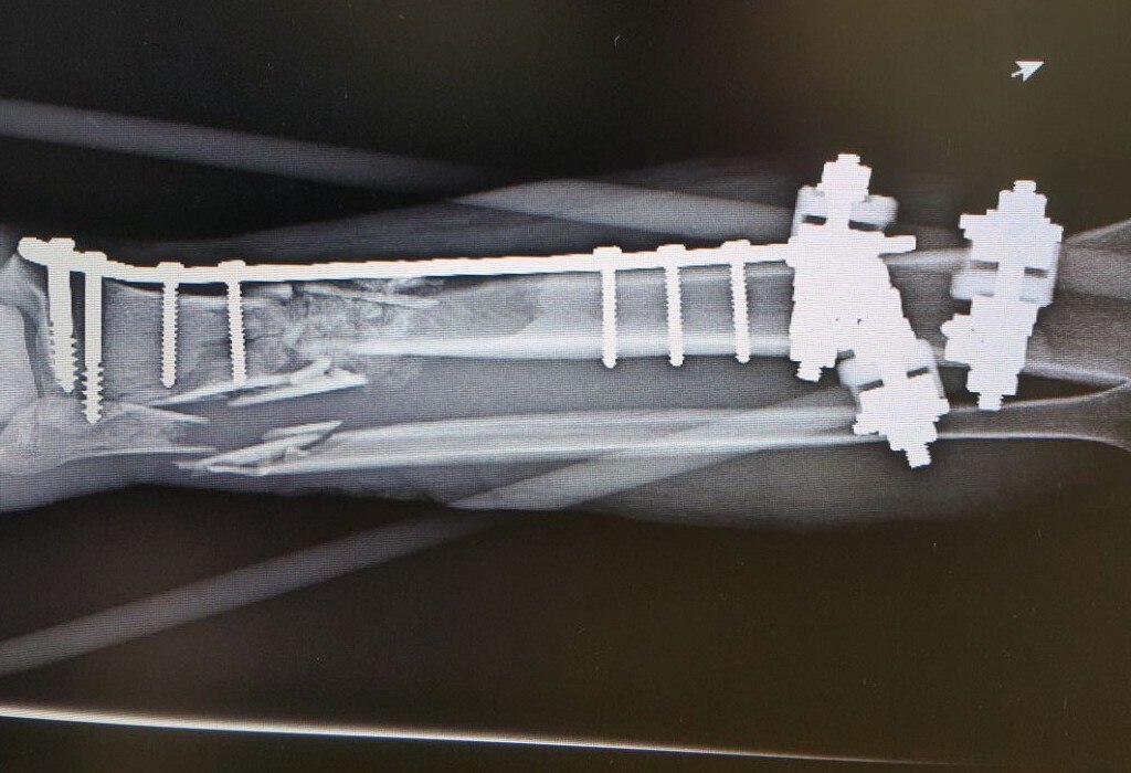Médicos del IMSS le salvan la pierna a un motociclista