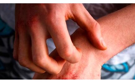 Ante cambio de bajas temperaturas, IMSS recomienda prevenir efectos en la piel