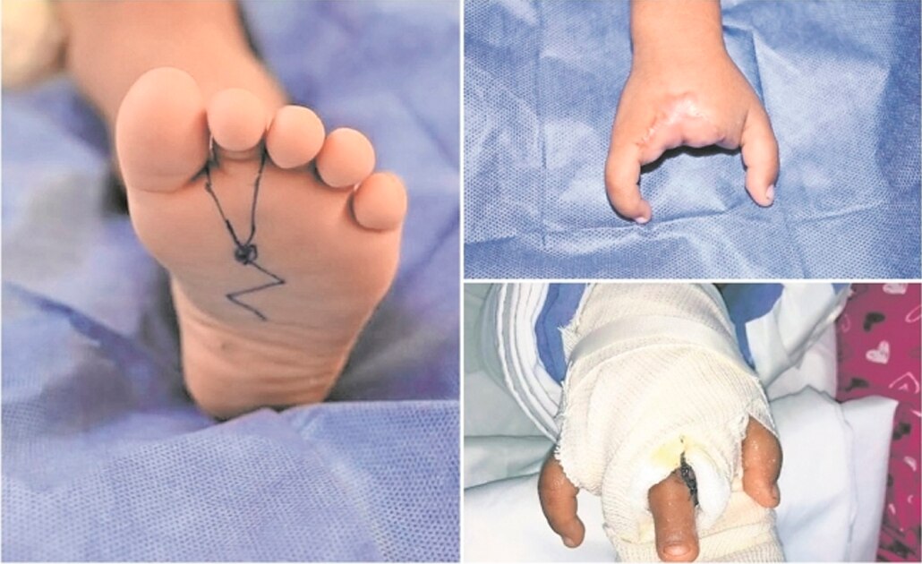 Logran transferencia de dedo de pie a mano