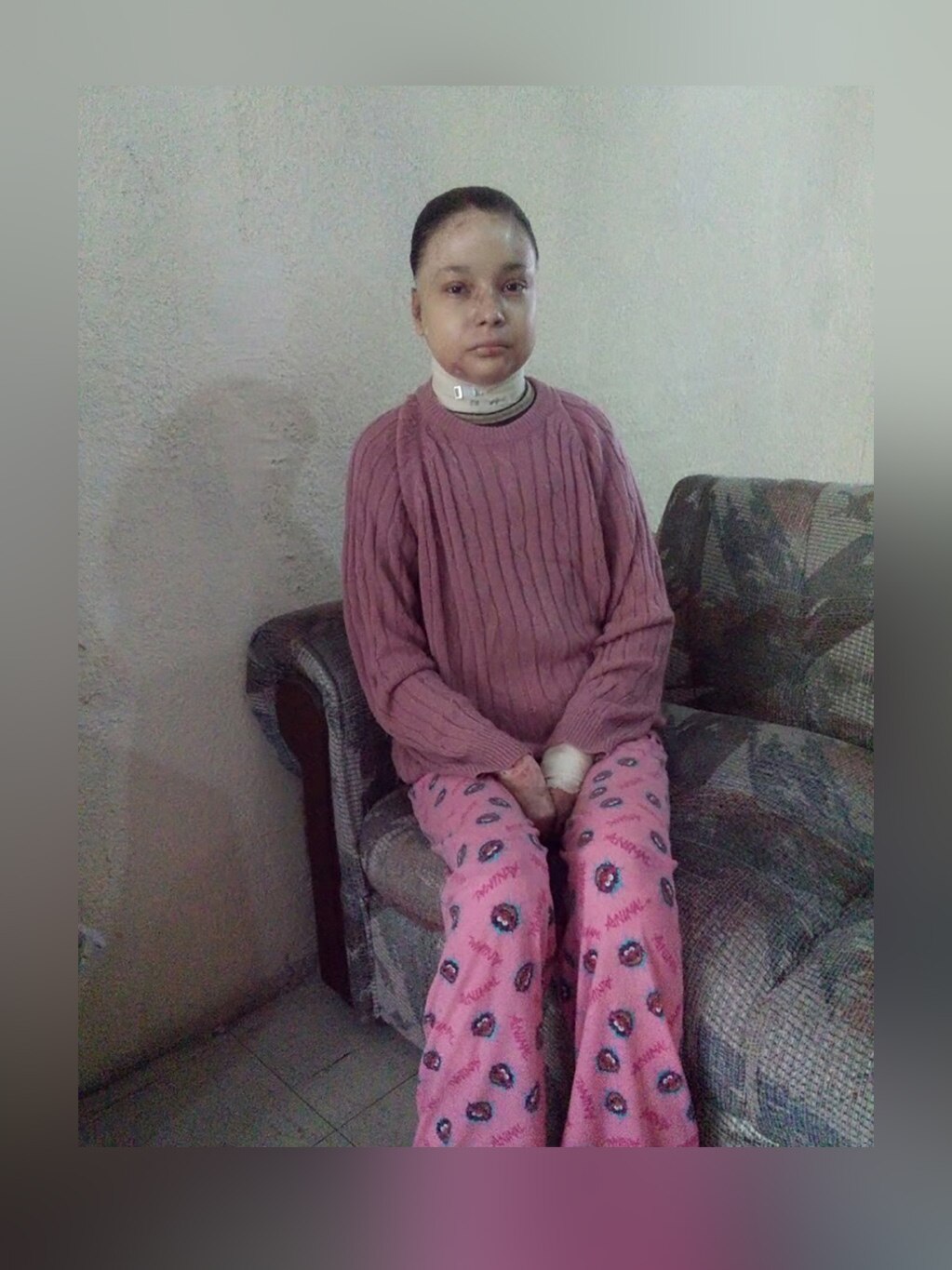 Piel de mariposa, enfermedad que no permite a Karen expandir sus alas