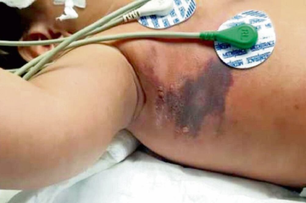 Autoridades sanitarias de Tepic dijeron que cuando obtuvieron el medicamento contra el veneno de la araña violinista, el niño Kevin Caaño, quien fue mordido por una de éstas, tenía comprometida la circulación en varias partes de su cuerpo (CORTESÍA)