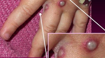 Viruela del mono: Cinco claves para comprender la infección