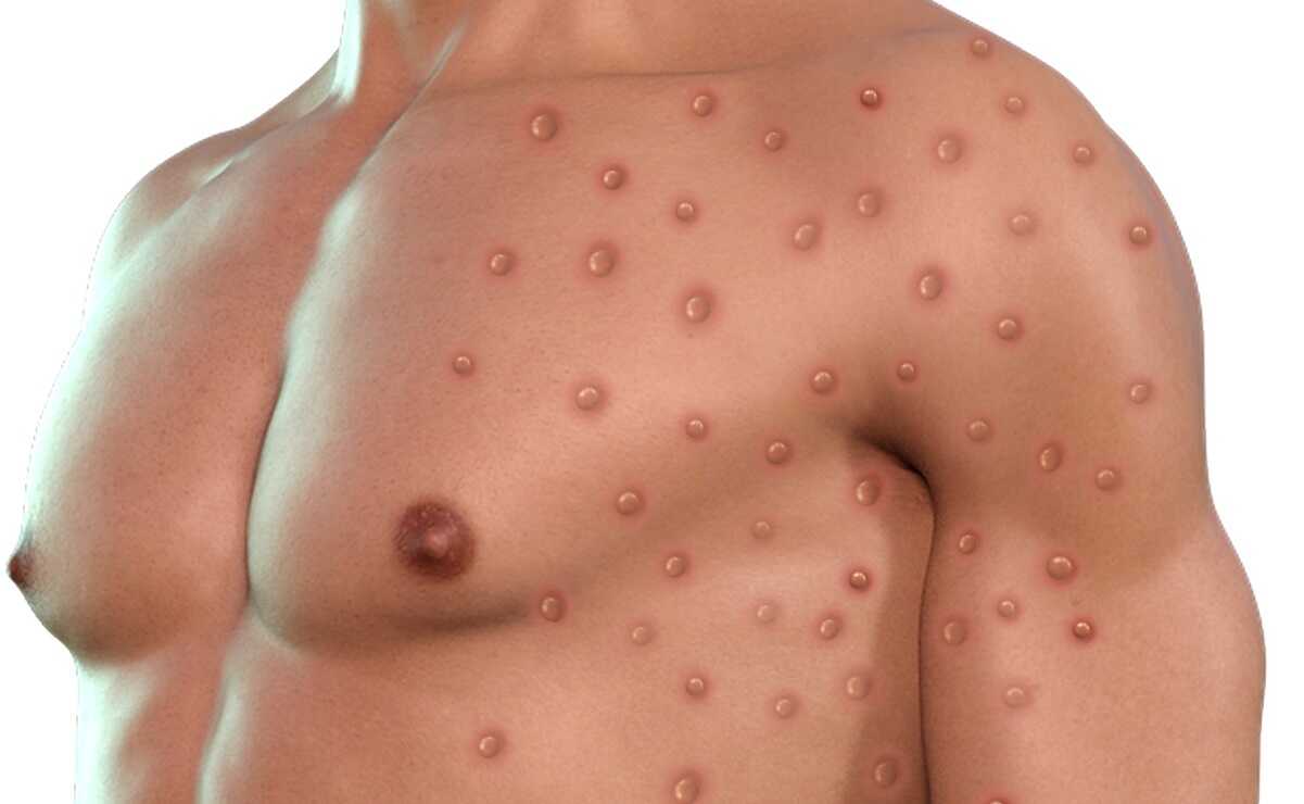 Confirman tercer caso de viruela del mono en San Luis Potosí. Foto: Pixabay