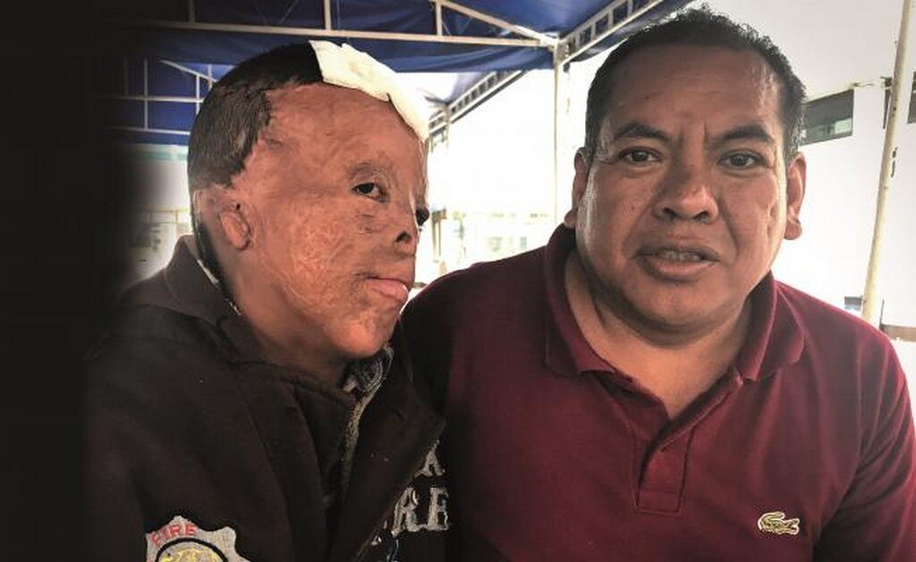 Juanito, 13 años luchando para sanar sus quemaduras