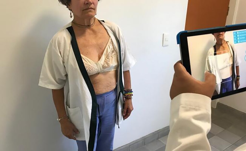 Estudiantes mexicanos elaboran prótesis mamarias en 3D