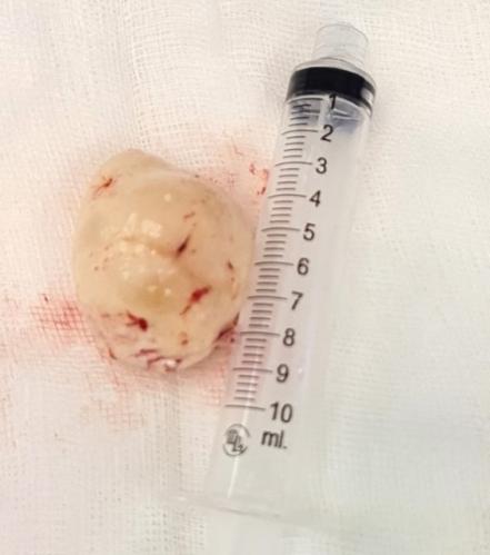 Mujer iba por operación de vesícula pero le retiran tumor del tamaño de un huevo