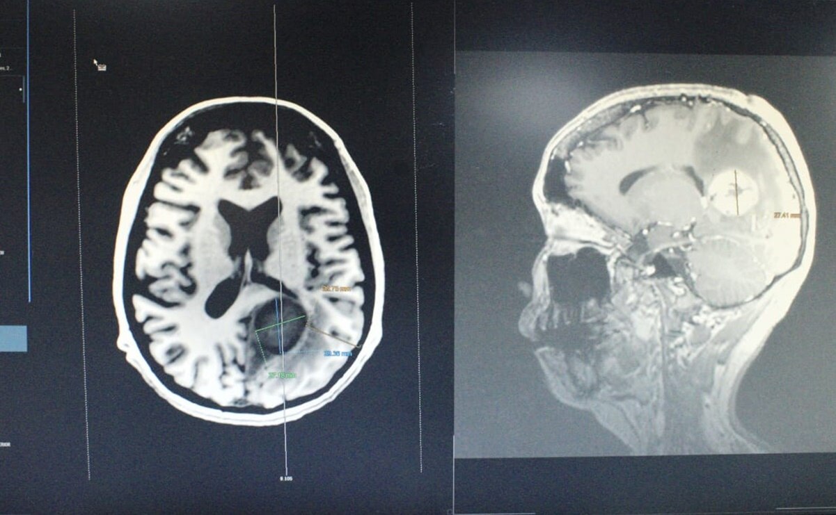 Mujer iba por operación de vesícula pero le retiran tumor del tamaño de un huevo