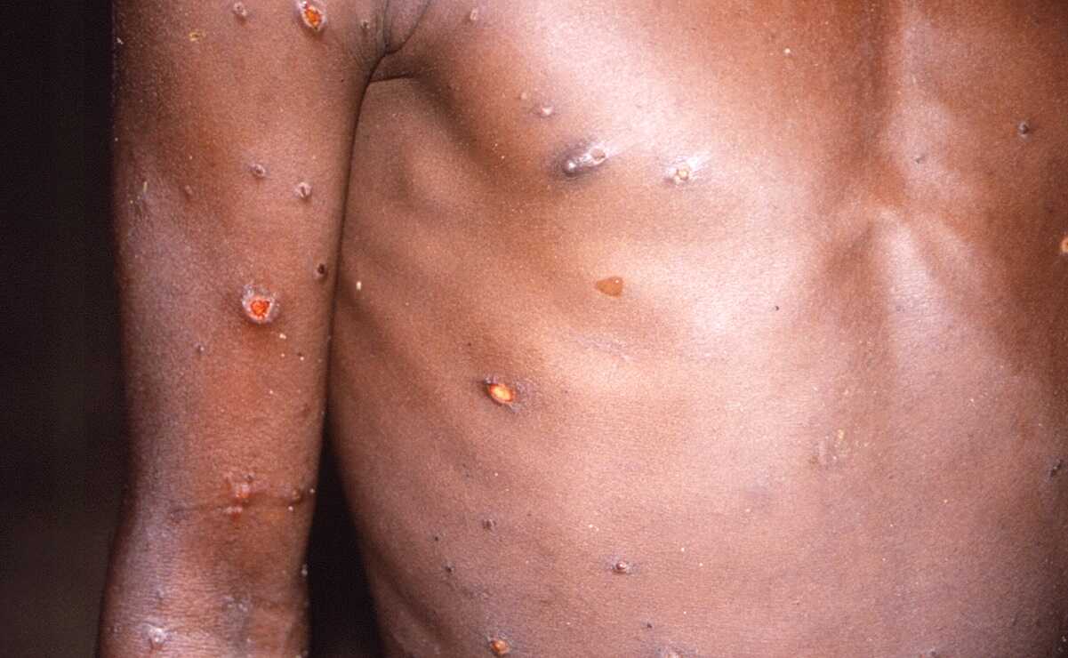 Lesiones de piel provocadas por la infección de viruela del mono.